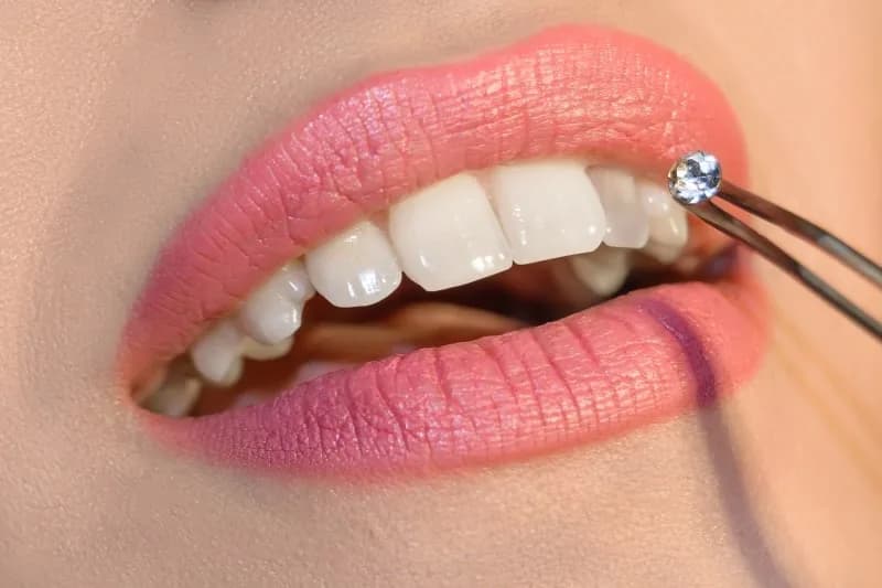 Tooth jewellery – cosmetic dentistry