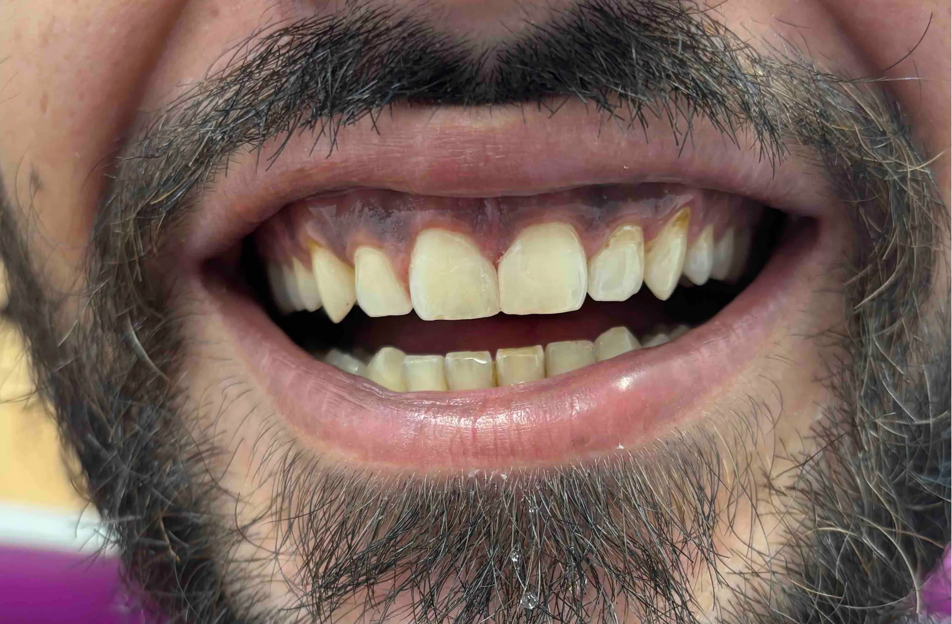 Bonding technique after the aesthetic restoration