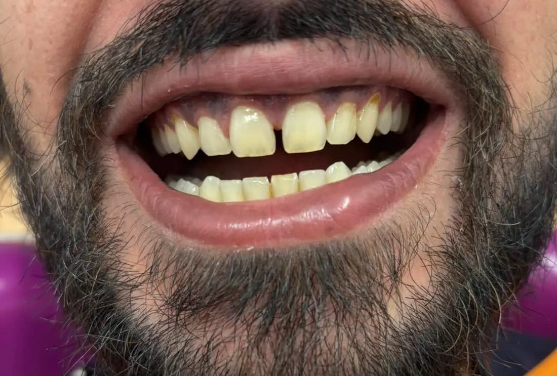 Bonding technique before the aesthetic restoration